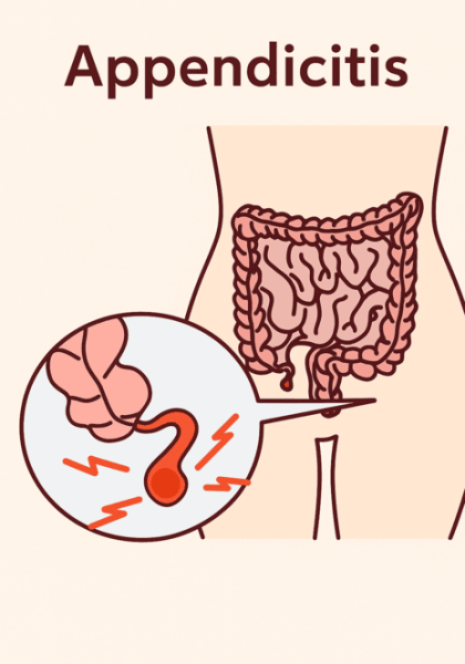 Appendicitis