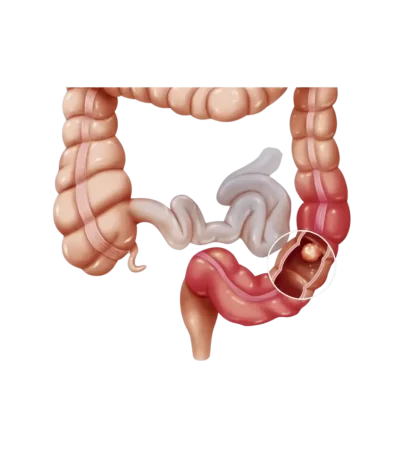 Bowel-Obstruction-Intestinal-Obstruction-2-1-1024x1024