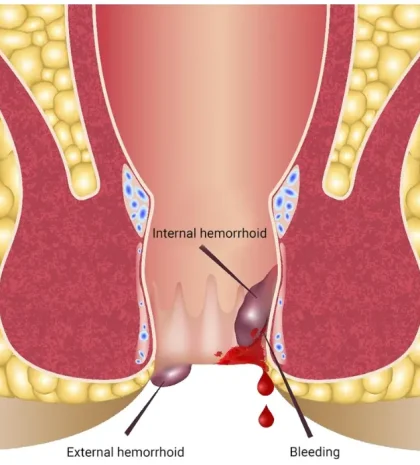 Haemorrhoids-Or-Piles