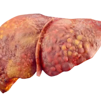 Liver-Cirrhosis-2