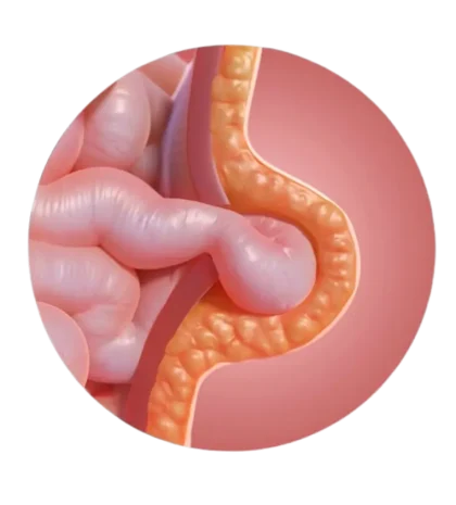 umbilical-hernia